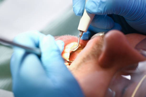 Best Emergency Tooth Extraction in Boulder, CO
