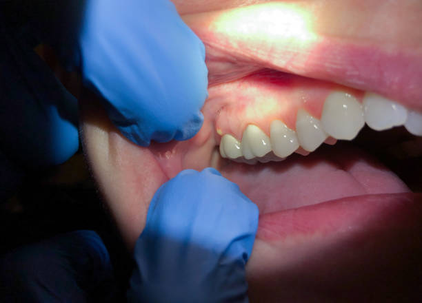 Best Urgent Care for Lost Fillings or Crowns in Boulder, CO